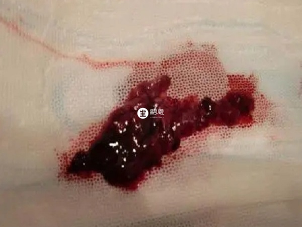 子宮內膜脫落是正常現象