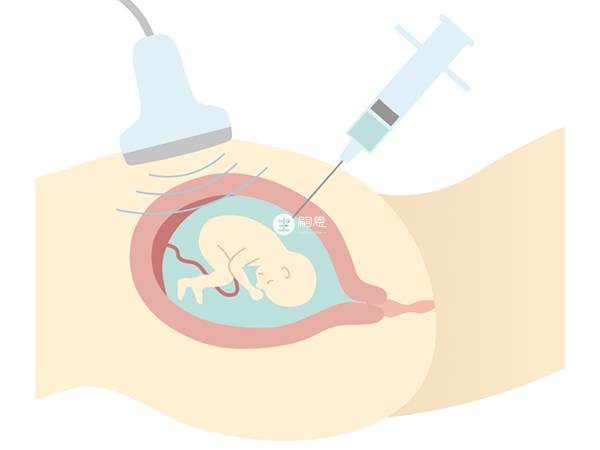 絨毛穿刺檢查操作不當會影響孩子的健康發育