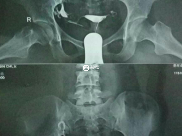 通水術可檢查輸卵管通暢情況