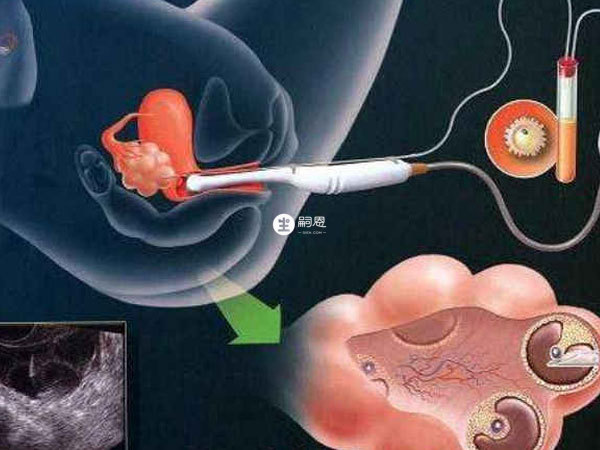 人工授精比試管嬰兒成功率低
