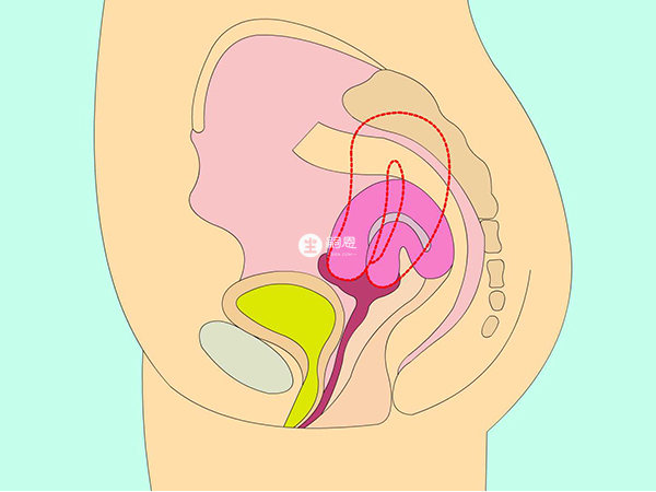 子宮前位顯懷多為下懷