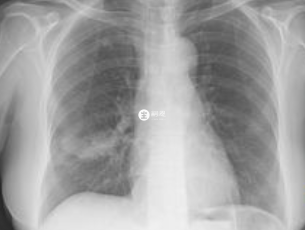 束縛帶可以避免肺部發炎