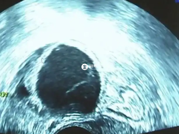 黃素化就是卵泡長大不排