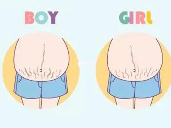妊娠纹判断生男生女图