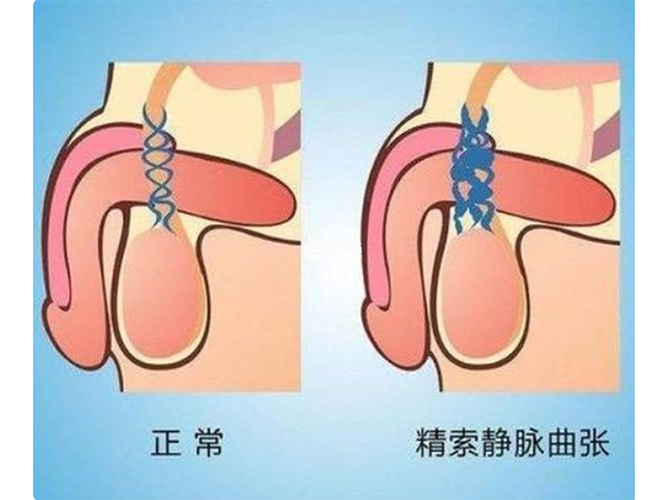 精索靜脈曲張只是引起弱畸精子症的諸多因素之一
