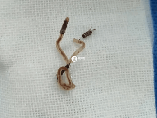 节育环主要通过宫内放置