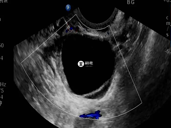 b超可以看出卵泡黃素化
