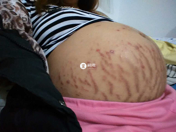 曼菲秀用一盒就能祛除妊娠紋不是真的