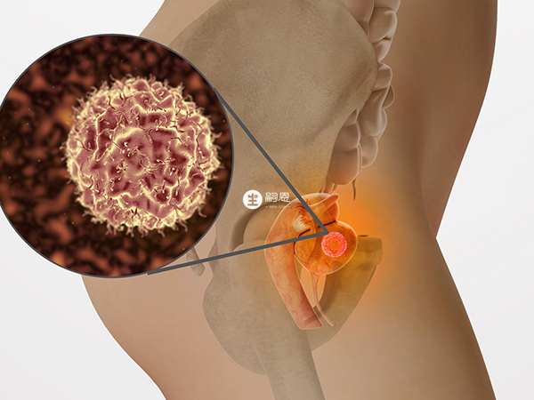 殘角子宮是一種先天性的發育畸形