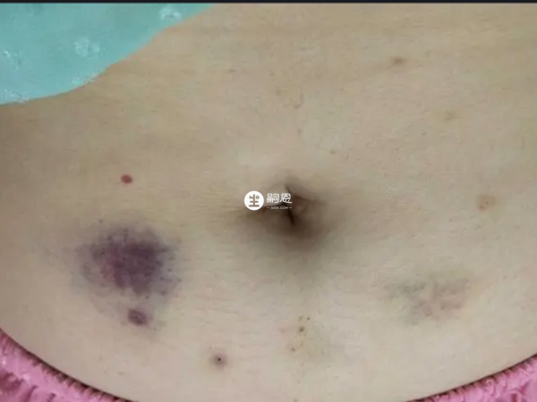 孕婦打肝素首選打肚皮