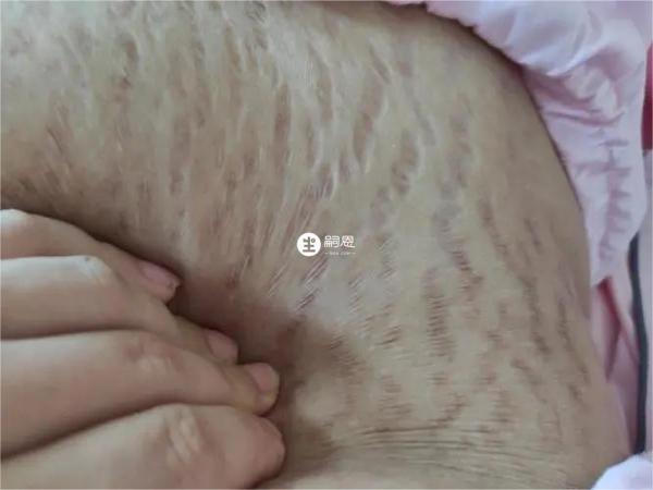 一般肥胖的人群更加容易長妊娠紋的