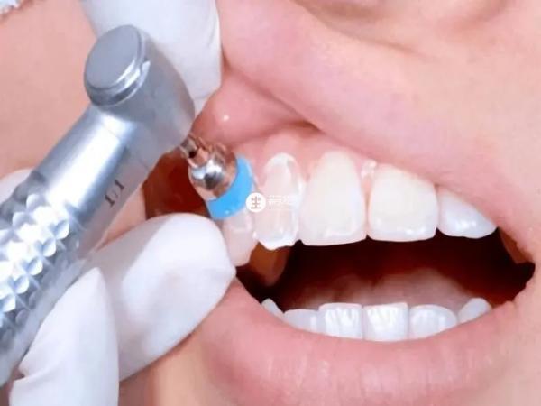 洗牙有利於口腔健康