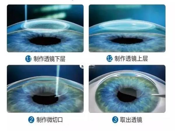 斜视手术能有效矫正视力