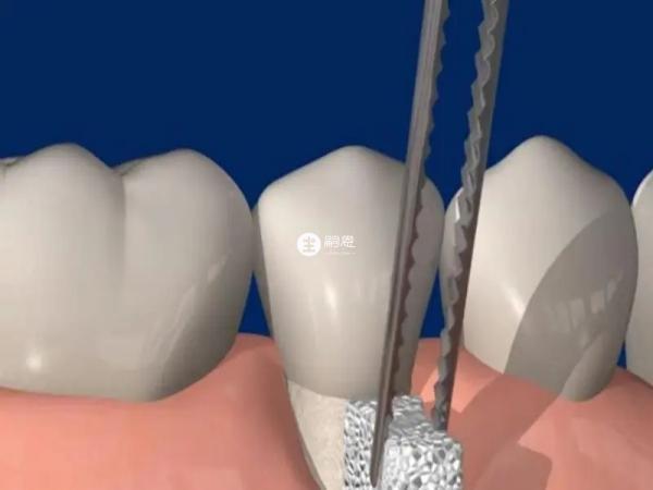 拔除4顆智齒後很多人會後悔