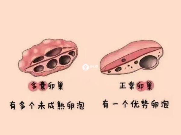 多囊并不会导致衰老加速