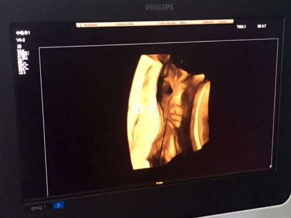 彩超可以判斷生男生女