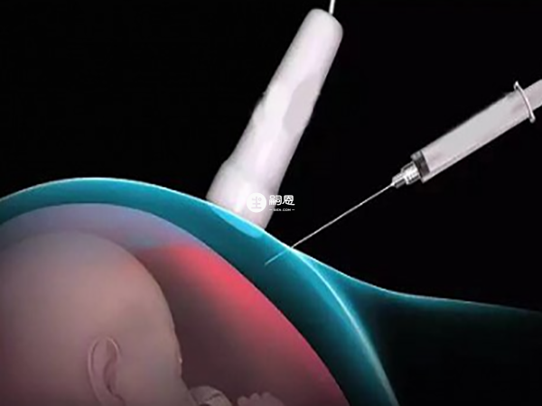 羊水穿刺可能刺傷胎兒