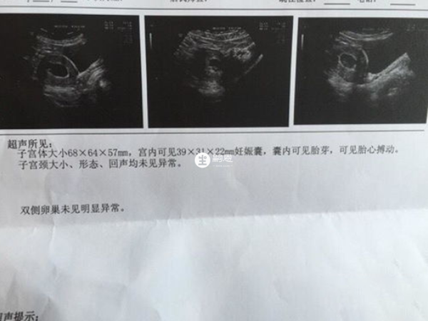 胎芽长和宽相差一倍以上怀男孩