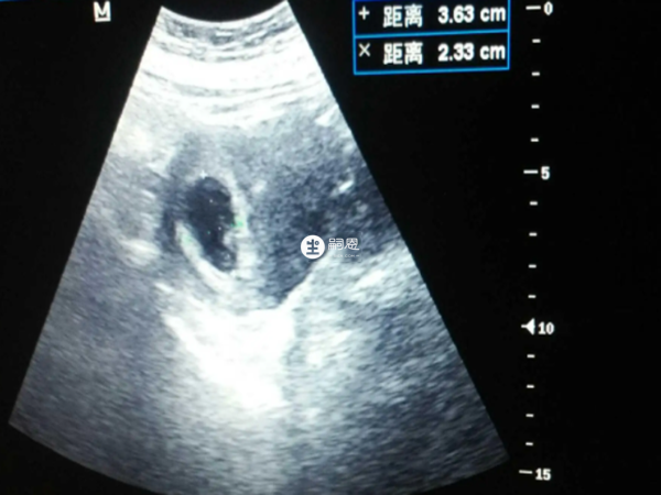 孕囊偏左看不出性別