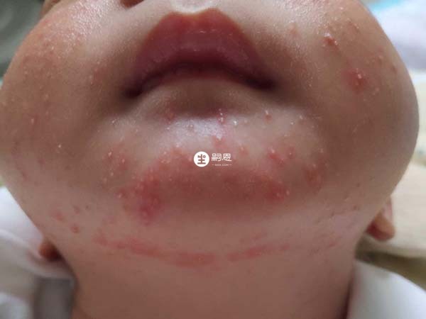 嬰兒患溼疹後需要及時治療