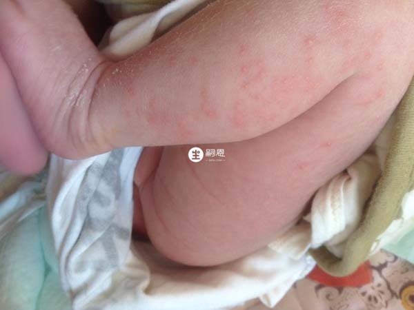 環境潮溼可能導致寶寶出現溼疹