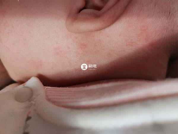 全身性溼疹可發生在全身任何部位