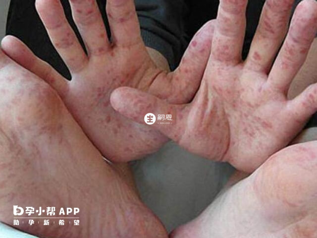 小兒手足口病具有傳染性