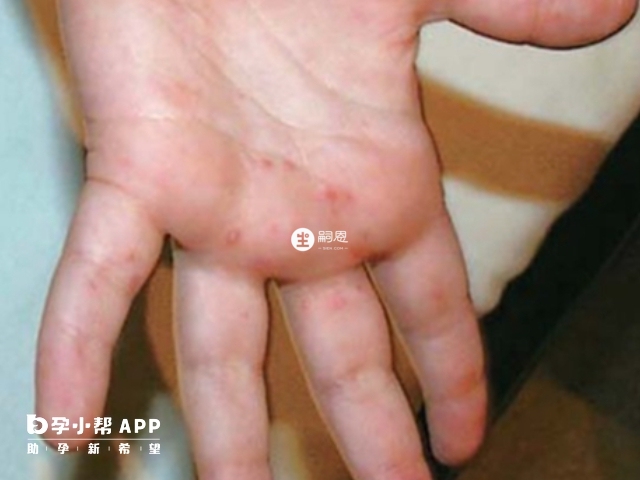 感染手足口病毒後手部長紅色的丘疹