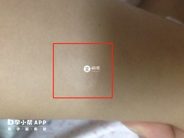 白色胎记又叫无色素痣
