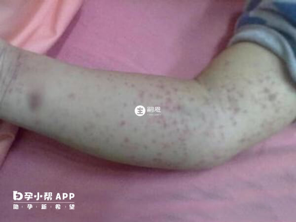 白血病早期紅疹圖片