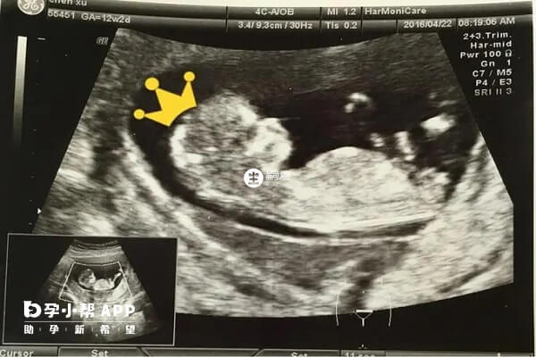 nt值小於1.5生男生女都有可能