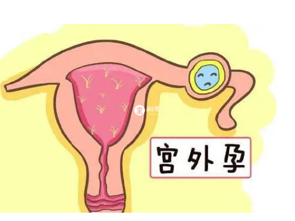 试管婴儿也可能导致宫外孕的发生