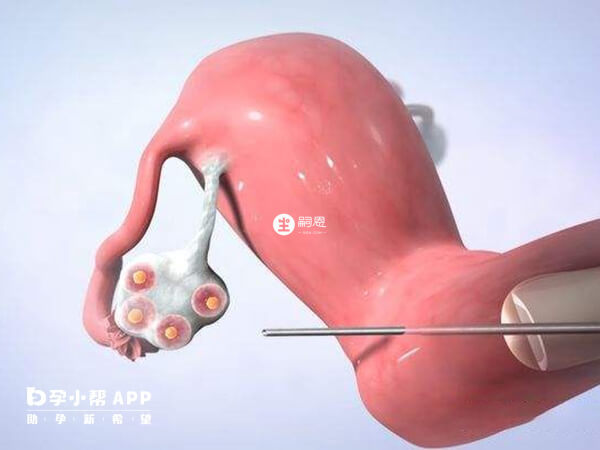 取卵数量受很多因素影响