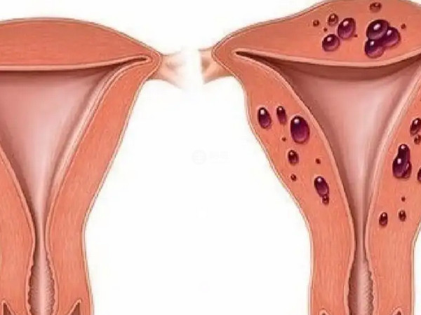 高齡有子宮腺肌症做試管成功率