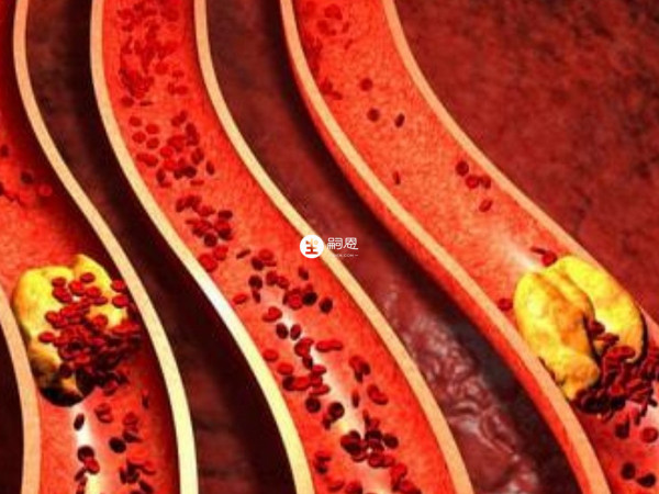 類風溼性血管炎