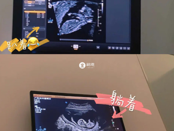 NT檢查是通過b超檢查胎兒頸部的透明度