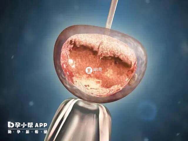 子宮縱隔切除後對移植成功率無影響