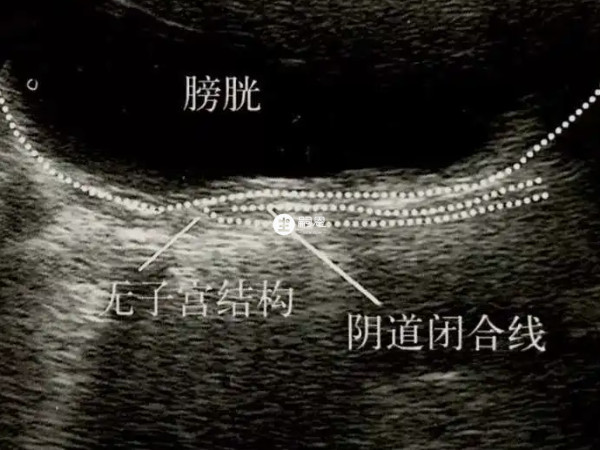 子宮缺如的意思是沒有子宮