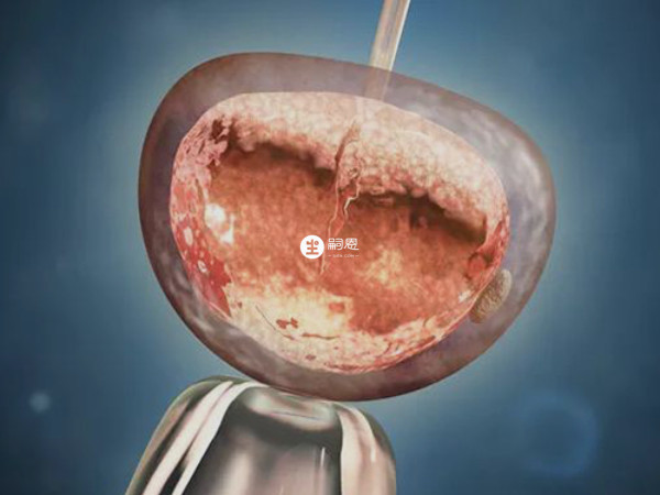 北京試管嬰兒納入醫保了