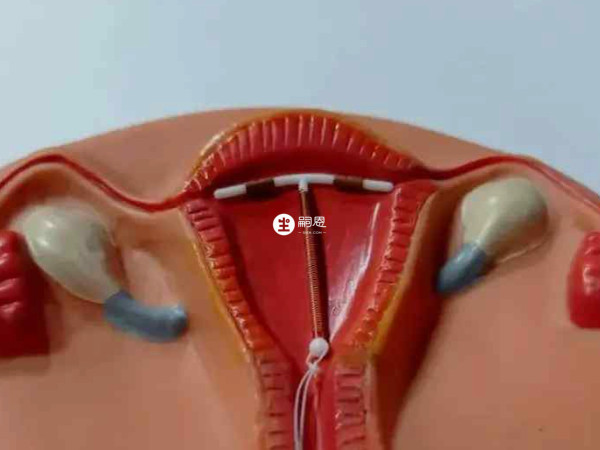 宮內節育器的優點