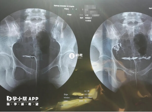 宮腔鏡檢查大部分患者當天就可以拿到結果