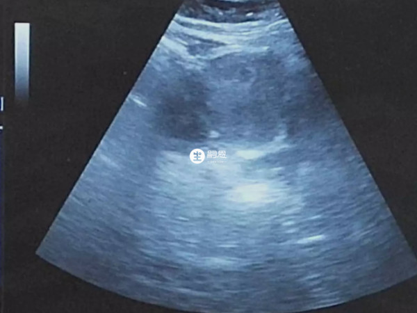 通常兩個孕囊是異卵雙胞胎