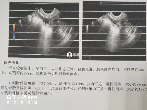 宮外孕超聲診斷單