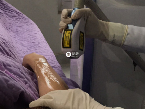 懷孕了不建做鐳射脫毛