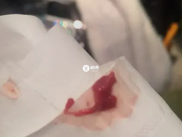 生化妊娠是先出現HCG下降再流血