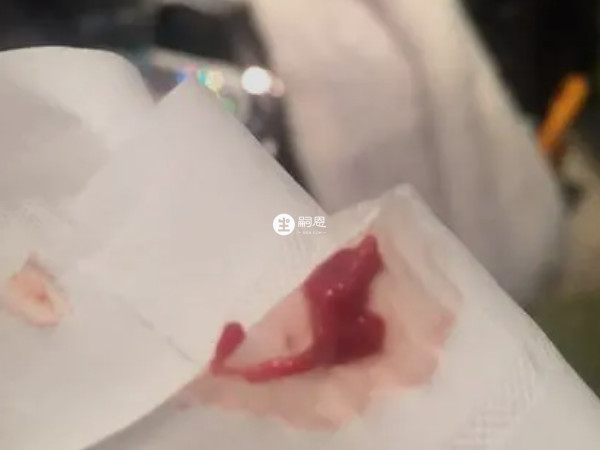 冻囊胚移植后生化妊娠预防方法