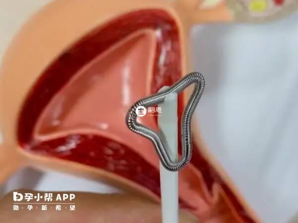 上環可以滿足長期避孕的效果