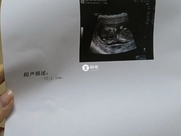 NT单子上出现三道杠也不一定会生女儿