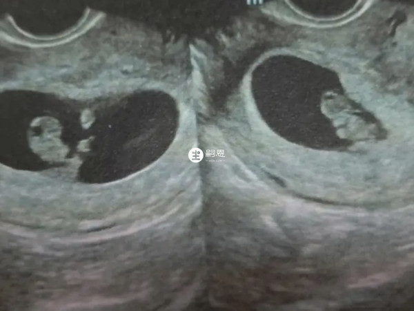 50天孕囊的資料判斷男女的方法