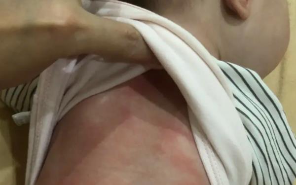 溼疹和熱疹在外觀上就有差別